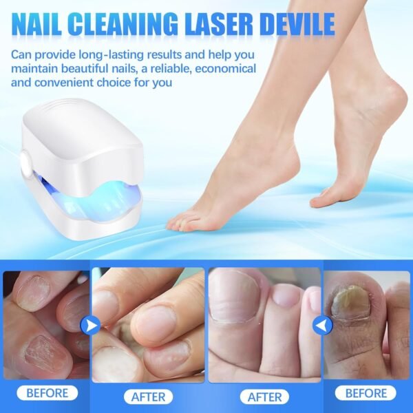 03_771cec4d-23d6-4e79-81ca-b6408c199daa.jpg Rechargeable Nail Fungus Laser – Anti-Fungal Device Toenails, Hands & Feet (Home Use)